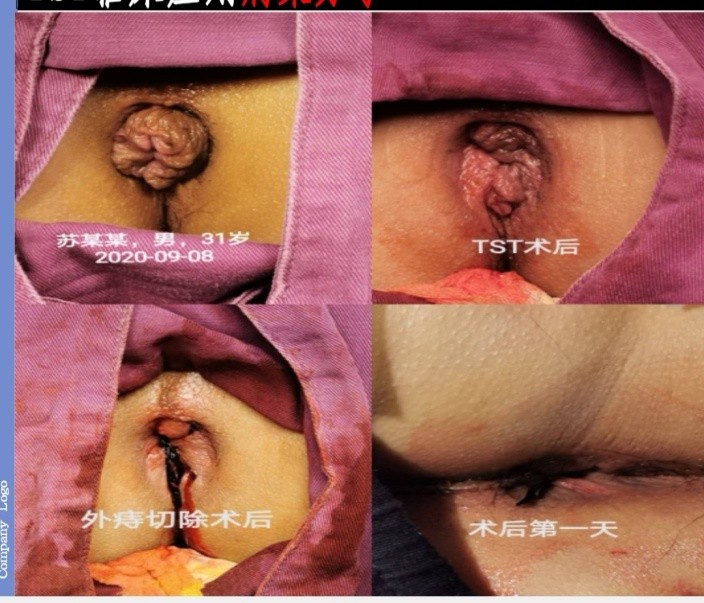 环状混合痔TST手术5.jpg
